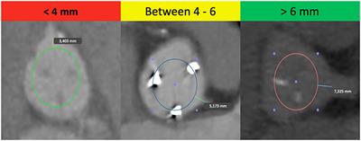 How to Avoid Coronary Occlusion During TAVR Valve-in-Valve Procedures